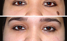 Cuidados post eliminación de lunares o verrugas